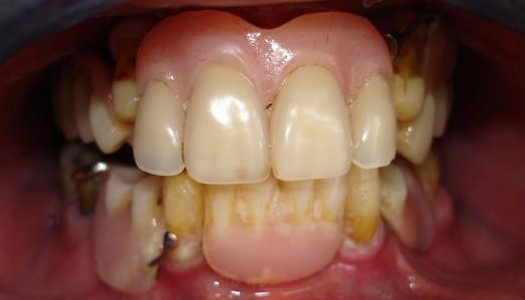 Valplast Full Dentures Amarillo TX 79101